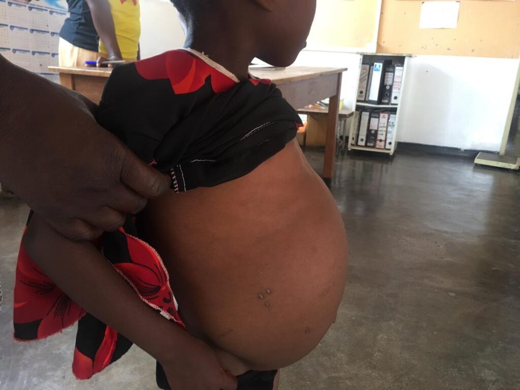 Five-year-old girl in rural Zimbabwe shows advanced chronic consequences (organomegaly) of untreated bilharzia (Photo credit: Professor Takafira Mduluza)